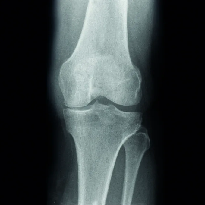 Preoperative xray 02